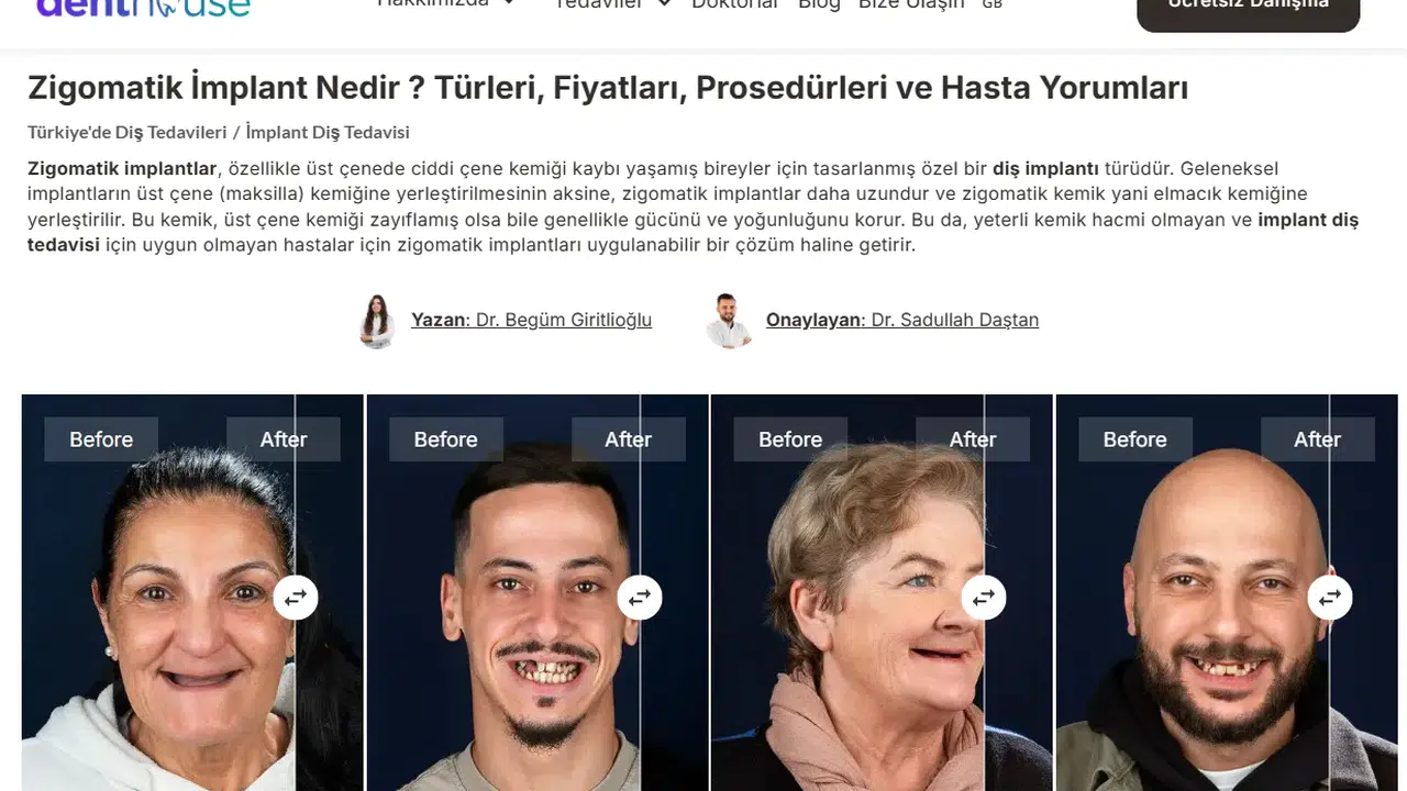 Zigomatik İmplant: Tanım, Uygulama Alanları ve Klinik Bilgiler