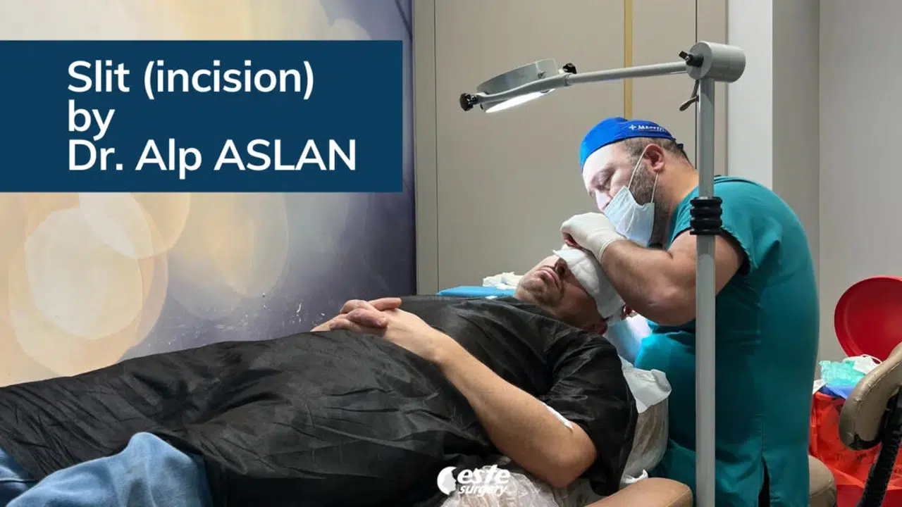 The Search for the Best Hair Transplant Technique 2026